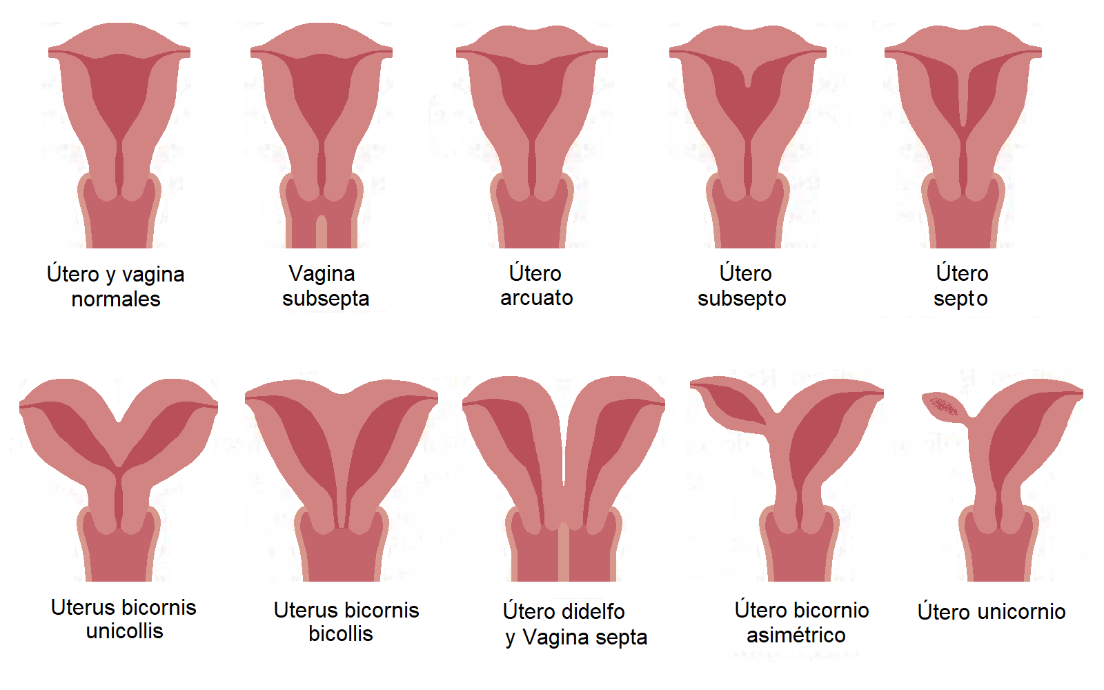 Esquema orientativo de anatomía uterina: útero habitual, septado, bicorne, didelfo y unicorne, con algunas variaciones vaginales.